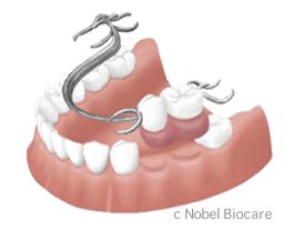 部分入れ歯
